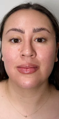 After: CO2 Laser