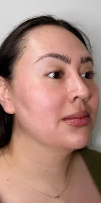 After: CO2 Laser