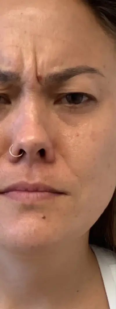 Before: Dysport - 50 units