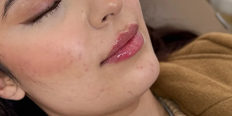 After: Lip Filler