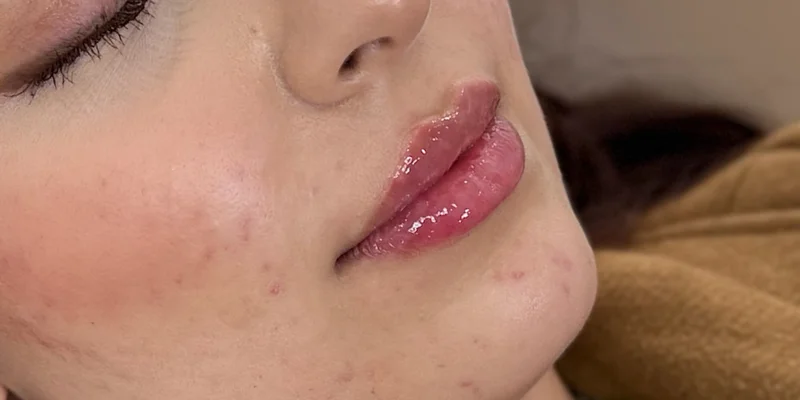 After: Lip Filler