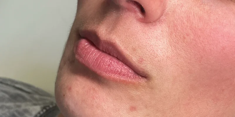 Before: Lip Filler