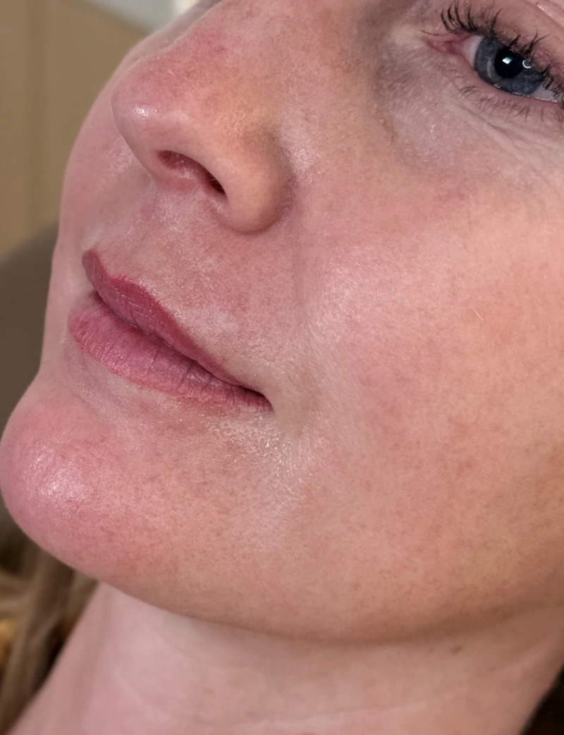 Before: Lip Filler - 1 syringe