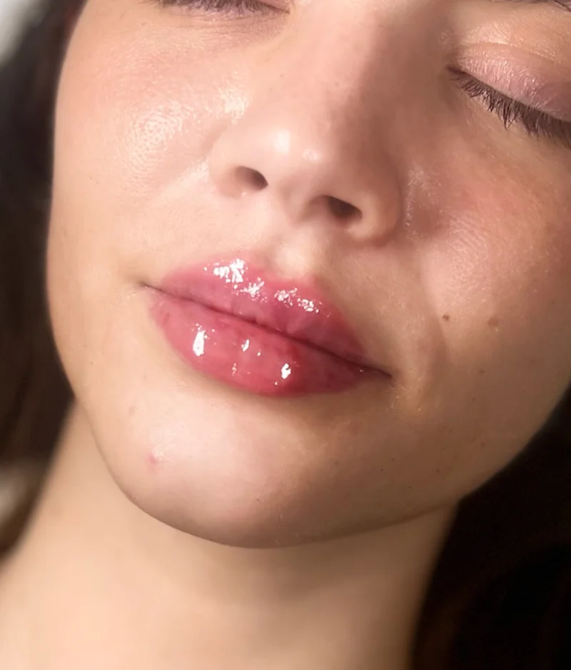 After: Lip Filler - 0.5 syringe