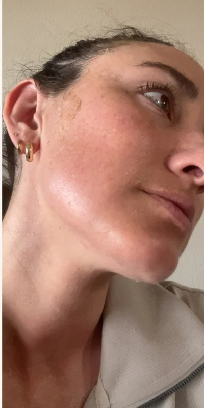 After: Microneedling - 3 sessions