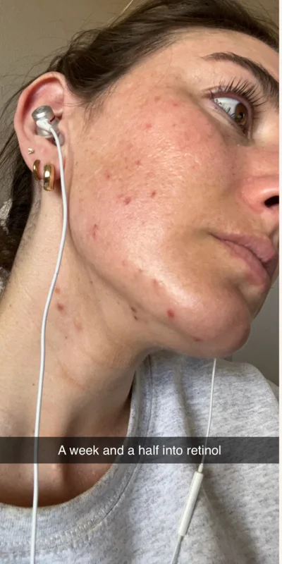 Before: Microneedling - 3 sessions