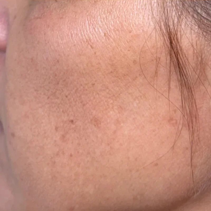 After: Microneedling - 3 sessions