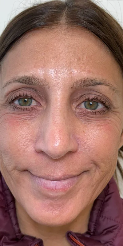 After: 6-month ZO Skin Health protocol targeting hormonal pigmentation