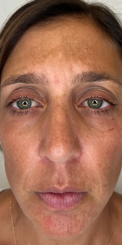 Before: 6-month ZO Skin Health protocol targeting hormonal pigmentation